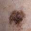 3. Stage 1 Melanoma Pictures