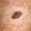 30. Stage 1 Melanoma Pictures