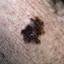 36. Stage 1 Melanoma Pictures