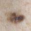 4. Stage 1 Melanoma Pictures