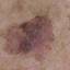 49. Stage 1 Melanoma Pictures