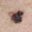 52. Stage 1 Melanoma Pictures