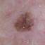 6. Stage 1 Melanoma Pictures