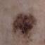 7. Stage 1 Melanoma Pictures