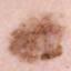 8. Stage 1 Melanoma Pictures