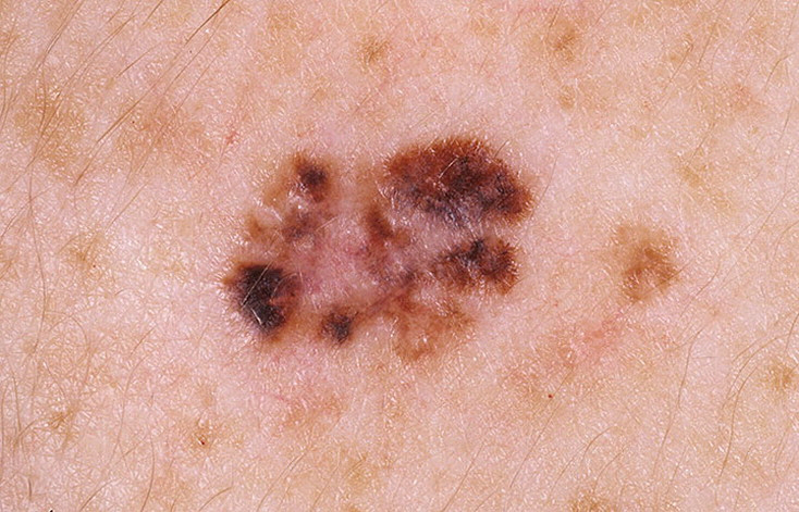 Stage 1 Melanoma Pictures 54 Photos And Images