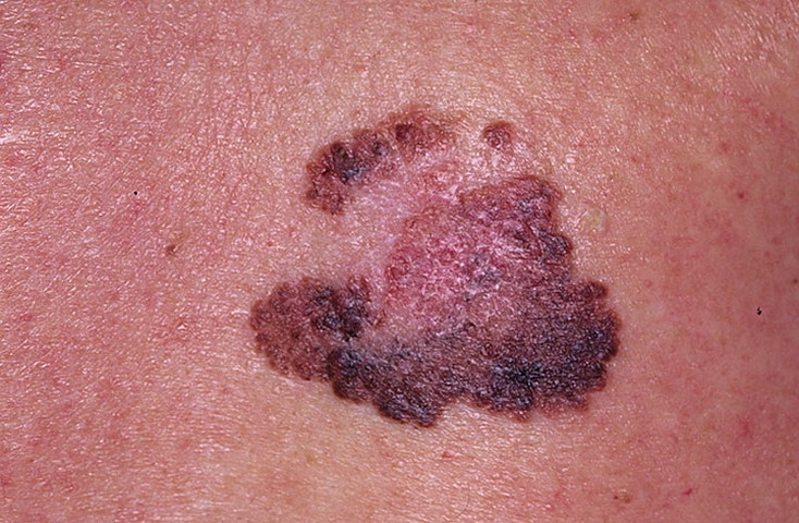Stage 1 Melanoma Pictures - 54 Photos & Images / illnessee.com