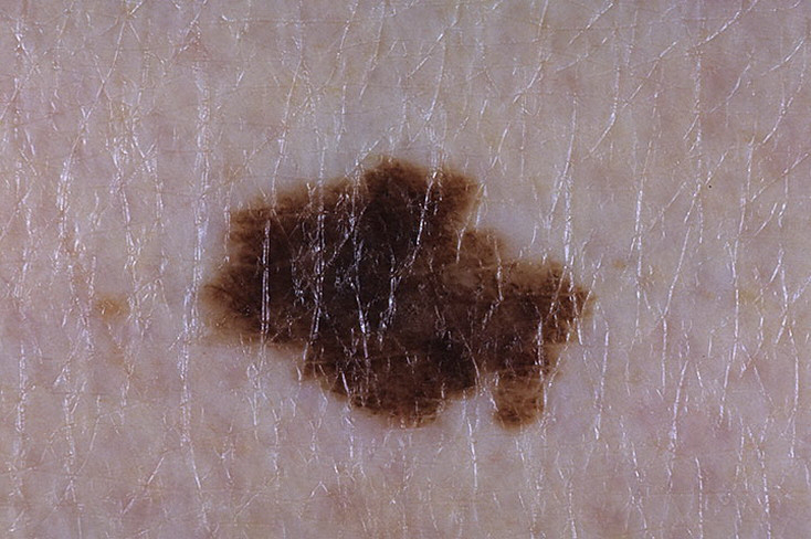 Stage 1 Melanoma Pictures – 54 Photos & Images / illnessee.com