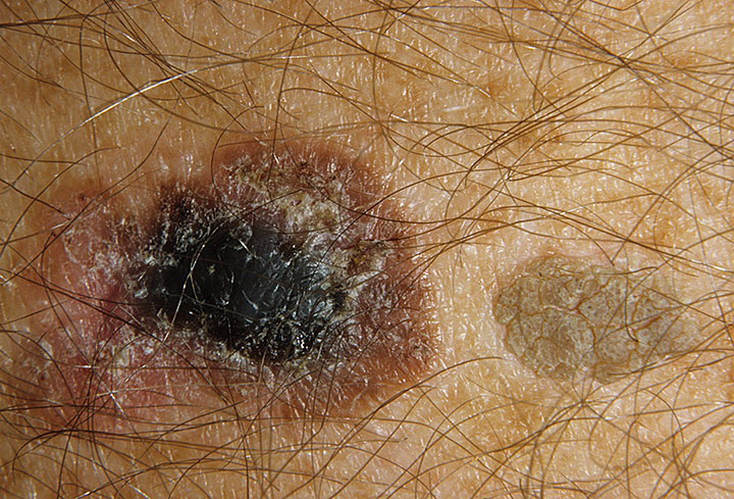 Stage 1 Melanoma Pictures – 54 Photos & Images / illnessee.com