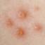 8. How Do Chicken Pox start Pictures