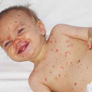 Chicken Pox in Babies