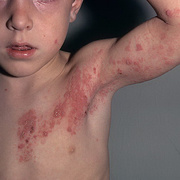Herpes Zoster in Children