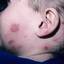 13. Herpes Zoster in Children Pictures